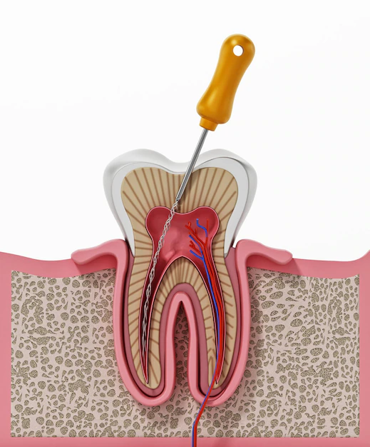 ROOT CANAL SPECIALIST IN BANASWADI