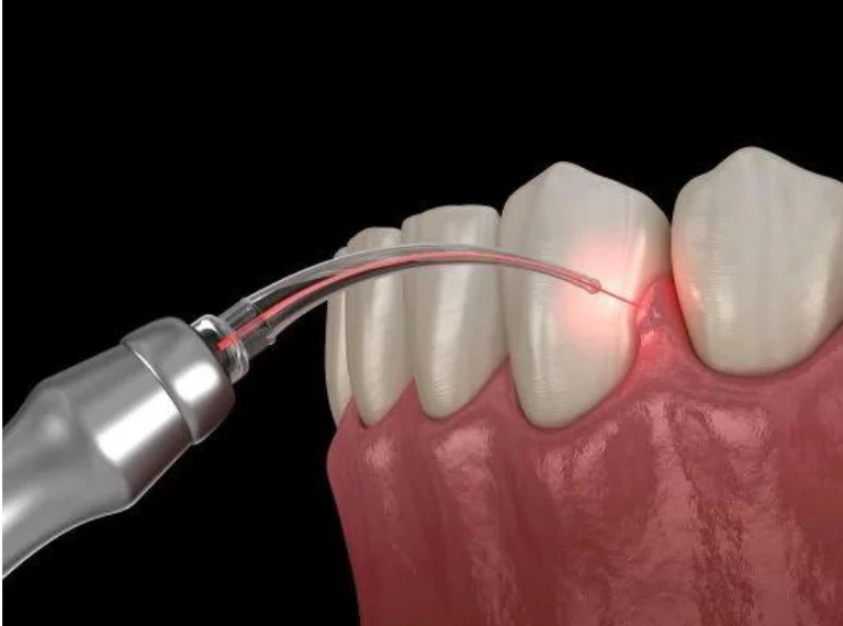 LASER TREATMENT IN HRBR LAYOUT
