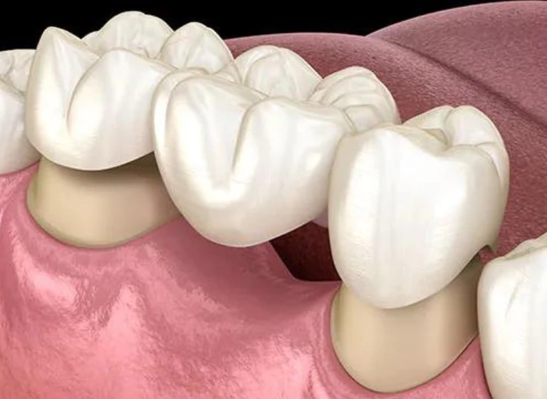 DENTAL CROWNS IN HRBR LAYOUT